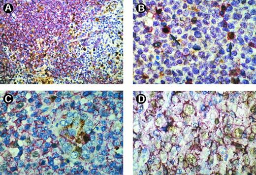 Fig. 2. (A) Double staining of CD20 (red) and cyclin D3 (brown) in a case of MCL. Lymphoma cells exhibit a B-cell phenotype with red membrane staining for CD20, whereas the nuclei are negative for cyclin D3. By contrast there are a number of cyclin-D3–positive brown labeled nuclei in the periphery of the tumor nodule, most probably belonging to reactive T cells that are CD20 negative. (A) Double staining of CD45R0 (red) and cyclin D3 (brown) in a case of MCL shows that most of the cyclin-D3–positive cells within this tumor display simultaneously T-cell properties (arrow). (C) Double staining of CD20 (red) and cyclin D3 (brown) in a lymphoma of MALT. There are few cells labeled for cyclin D3 in their nuclei. These cells also exhibit CD20 staining with one double labeled cell within the epithelium of a gastric gland (arrow). (D) Double staining of CD20 (red) and cyclin D3 (brown) of a large B-cell lymphoma. There are a number of cyclin-D3–positive cycling cells that also show CD20 expression.