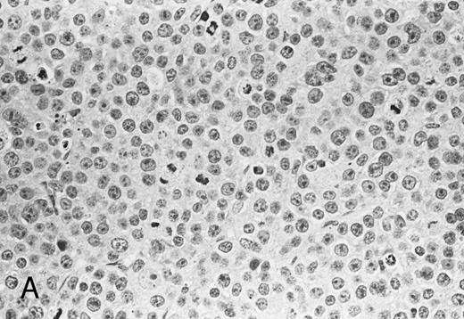 Fig. 4. Histologic findings of RPMI 8226 tumors at day 25 after tumor inoculation. The subcutaneous tumors in SCID mice were removed 3 days after injection (100 μg/mouse) of (A) control IgG or (B) anti-HM1.24 MoAb. Necrotic areas and infiltrating cells were seen in the tumor from mice treated with anti-HM1.24 MoAb. Stained with hematoxylin and eosin. Original magnification ×130.
