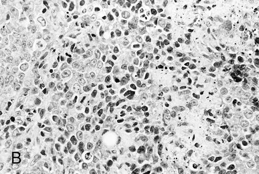 Fig. 4. Histologic findings of RPMI 8226 tumors at day 25 after tumor inoculation. The subcutaneous tumors in SCID mice were removed 3 days after injection (100 μg/mouse) of (A) control IgG or (B) anti-HM1.24 MoAb. Necrotic areas and infiltrating cells were seen in the tumor from mice treated with anti-HM1.24 MoAb. Stained with hematoxylin and eosin. Original magnification ×130.