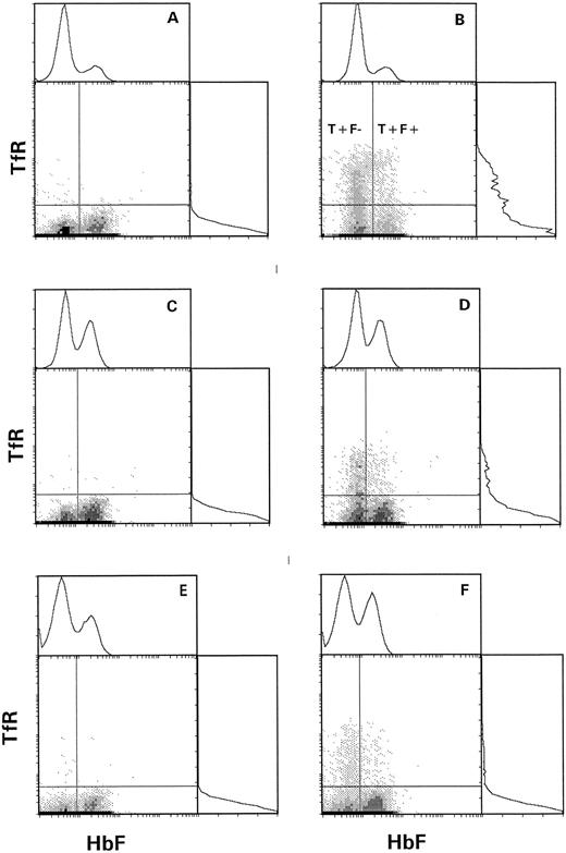 Fig. 1. Two-parameter analysis of HbF and TfR in density-fractionated sickle cells. F cell analysis is on the x-axis, with positive and negative regions determined by the nadir between the two peaks. The positive region for transferrin receptor was determined with the aid of matched nonspecific IgG (idiotype control). The regions containing T+F− and T+F+ cells are indicated. (A) Fraction I, idiotype control. (B) Fraction I, anti-TfR. (C) Fraction II, idiotype control. (D) Fraction II, anti-TfR. (E) Fraction III, idiotype control. (F ) Fraction III, anti-TfR.