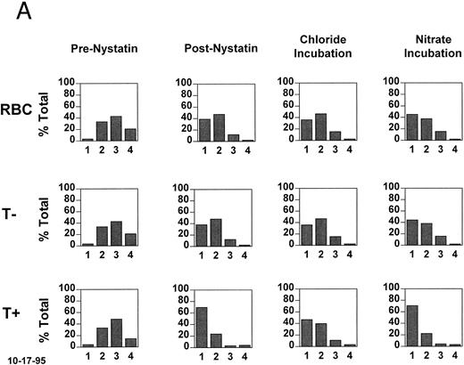 Fig. 3. Density changes that occur in T+ sickle cells during short oxygenated incubations and their dependence on HbF. Fraction II cells were treated with nystatin to normalize their K+ content and hydration and incubated for 20 minutes at pH 7.2 in the presence and absence of chloride. A secondary density fractionation was performed and the T+ cells were identified. (A) The secondary density distributions of all RBCs, T− cells, and T+ cells before nystatin treatment, after nystatin treatment, and after incubation of the normalized cells in the presence or absence of chloride. The expected chloride-dependent density shift in T+ cells takes place. (B) For the postnystatin and chloride-incubated samples, cells were also analyzed for HbF, and the density distributions of T+F− and T+F+ cells were determined. Both subtypes had the same tendency to become more dense when incubated under these conditions.