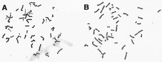 Fig. 5. Cytogentic analysis of retroviral-transduced FAA lymphoblasts. (A) A representative metaphase spread from the cell line EUFA 528 following incubation with MMC (40 ng/mL). Chromatid breaks (→), and exchanges (➞) are indicated. (B) Metaphase preparation of retroviral-transduced EUFA 528 cells following exposure to MMC.