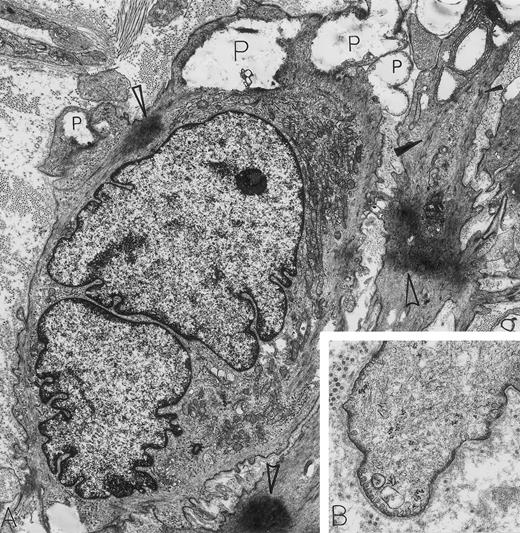 Leiomyosarcoma. A 56-year-old woman presented with abdominal pain and a 30-lb weight loss; a retroperitoneal mass was found. By electron microscopy, all features diagnostic for a metastatic leiomyosarcoma were present. These include caveolae, basal lamina, attachment plaques (all best seen at higher magnification in B), and bundles of microfilaments with dense bodies enclosed (closed arrowheads in A). Additional features of these spindle-shaped tumor cells of smooth muscle cell origin include large electron-dense masses of contracted actin filaments (open arrowheads in A), blunt, club-shaped surface projections (seen at higher magnification in B) and electron-lucent cytoplasmic pools representing admixed glycogen and lipid (P). Note that strands of rough endoplasmic reticulum are not dilated and are inconspicuous in these leiomyosarcoma cells displaying primarily a contractile phenotype. The light microscopic immunoperoxidase profile was positive for vimentin, muscle-specific actin and desmin, and negative for S-100, neurofilament, keratin, and α-1-antitrypsin for this tumor. (A) Original magnification × 8,000; (B) Original magnification × 24,000. (Courtesy of Ann M. Dvorak, MD, Department of Pathology, Beth Israel Deaconess Medical Center, 330 Brookline Ave, Boston, MA 02215.)