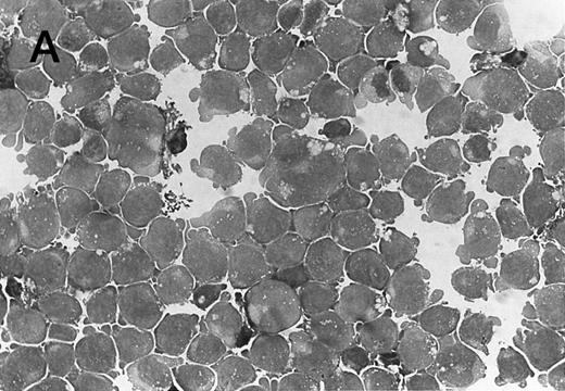 Fig. 3. Morphology of CMK cell cytospins, Wright stained, and photographed at 400×. (A) Parental CMK cells showing an immature phenotype. The majority of cells have a single noncondensed nucleus with a small amount of cytoplasm. (B) Parental CMK cells treated with PMA. The cells show signs of differentiation including increased cell size, increased amount of cytoplasm, increased vacuolation of the cytoplasm, and an increased nuclear density with areas of multinucleation. (C) Vector control transfected CMK clone showing an immature phenotype. (D) WT Mek transfected CMK clone showing an immature phenotype. (E) DE Mek transfected clone showing a differentiated phenotype. (F ) D330N Erk transfected clone showing a differentiated phenotype.