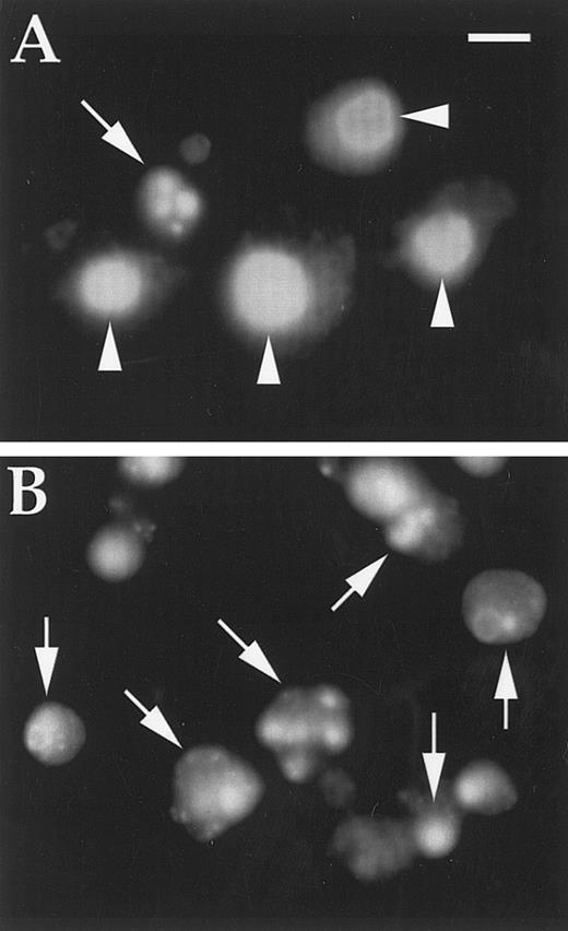 Fig. 6. DAPI-stained cells treated with DT388–GM-CSF as described in text. (A) K562 cells (one apoptotic cell); (B) U937 cells (all apoptotic cells). Magnification is × 600; scale bar represents 10 μm; arrows indicate apoptotic nuclei; arrowheads indicate normal nuclei.