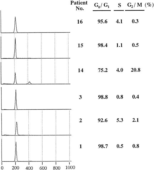 Fig. 3. Cell cycle distribution of AML blasts with or without overexpressed cyclin E. In each sample, a total of 10,000 cells were analyzed, and the half peak CV was between 1.5 and 2.6. Histograms show PI-stained cellular DNA. DNA-staining fluorescence intensity on a linear scale (X-axis) and cell number (Y-axis) are represented. The right hand table shows the percentage in G0/G1, S, and G2/M phase. Patients no. 1, no. 2, and no. 3 correspond to respective numbers in Table 2.