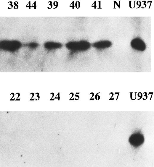 Fig. 5. The expression of p27 gene product. Western blotting probed by anti-p27 antibody was performed. Equal amounts of whole cell lysates (10 μg) from AML samples with enhanced cyclin E expression (upper panel) and those without enhanced cyclin E (lower panel) were analyzed. Each number over the lane corresponds to the patient number in Table 2. “N” and “U937” represent the lysates from mononuclear cells in normal BM and U937 cells.