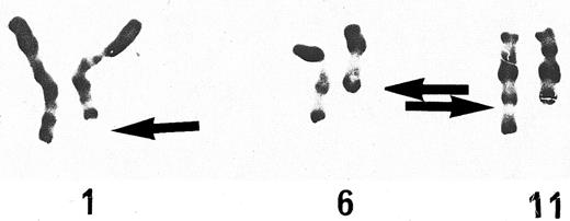 Fig. 1. Partial karyotype (RHG-banding) for del(1)(q41) and t(6; 11)(q21; q23). Arrows show the rearranged chromosomes.