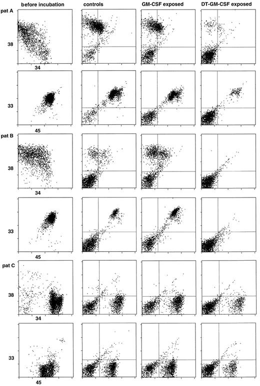 Fig. 2. Double-labeling dot plots of three different AML's. The first lane shows the CD38 (Y-axis) versus CD34 (X-axis) and CD33 (Y-axis) versus CD45 (X-axis) of the original cell suspensions before incubation and injection into the SCID mice. Lanes 2, 3, and 4 show CD38/34 and CD33/45 double-labeling dot plots of BM derived from SCID mice that were killed around day 40 after injection of AML cells that were either incubated for 48 hours in serum-free medium (SFM) lane 2; in SFM containing GM-CSF only, lane 3; or in SFM containing DT-GM-CSF at 100 ng/mL, lane 4. Murine cells are found in the lower left quadrant and depending on the characteristics of AML A, B, or C, human cells are found in the other three quadrants.