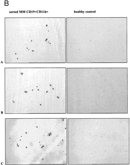 Fig. 5. CD11b+ B cells coexpress CD34, which identifies the clonotypic subset. (A) PBMC from 3 different MM patients were stained with CD11b-PE and CD34-FITC. The box indicates the set of cells for which multidrug transporter function has been analyzed in Figs 1, 3, and 6 and Table 1. (B) In situ RT-PCR amplifies clonotypic transcripts from sorted CD19+ 11B+ MM B cells but not from normal B cells. The left column of panels show in situ RT-PCR on CD19+11B+ B cells from (A) patient no. 11, (B) patient no. 6, and (C) patient no. 13. The right column shows patient-specific in situ RT-PCR on CD19+ B cells from healthy donors. Row (A) used primers specific for patient no. 11, row (B) primers specific for patient no. 6 and (C) primers specific for patient no. 13.