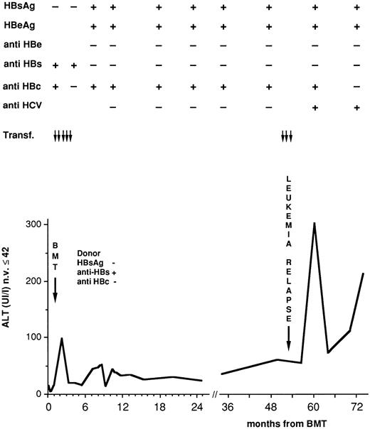 Fig. 2. Serologic and biochemical profiles in a leukemic child who became an HBsAg, HBeAg carrier 7 months after BMT from a sister vaccinated for HBV.