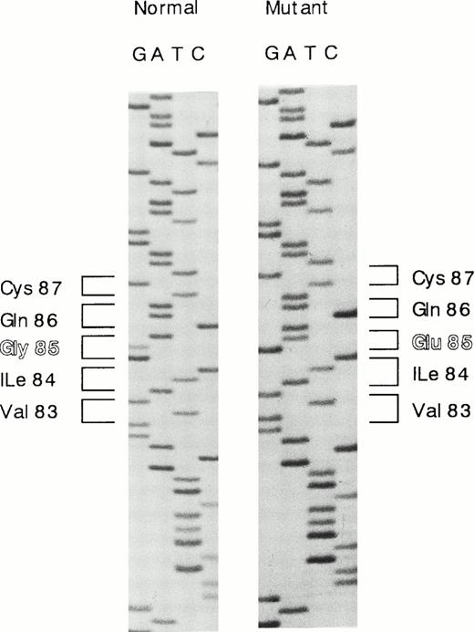 Fig. 1. Nucleotide sequence showing the G to A substitution in exon 3 of the HRG gene. G to A substitution at nucleotide position 429 mutates Gly85 to Glu in the first cystatin-like domain.