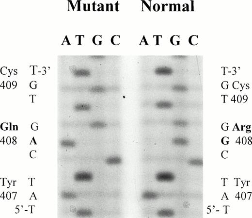 Fig. 1. DNA sequence analysis of exon 10 of the FXIIIA gene. The G → A mutation, Arg408Gln, identified is indicated. The patient appears to be homozygous for this sequence change.