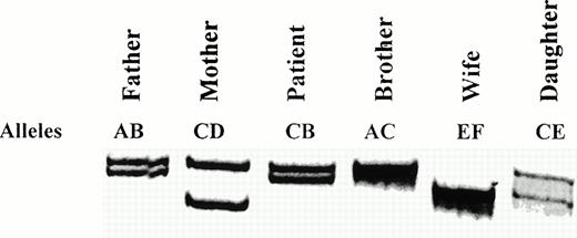 Fig. 4. Segregation of the FXIIIA (AAAG)n STR alleles. All relations are defined with respect to the patient. Alleles are arbitrarily labeled AB for the father, CD for the mother, and EF for the wife. The alleles inherited by each family member are indicated.