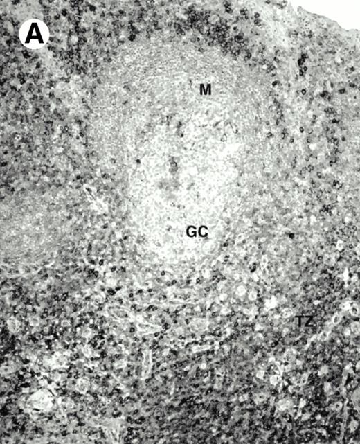 Fig. 8. Expression of PSGL-1 in human tissues. (A) Paraffin tonsil stained with KPL1. The vast majority of the lymphocytes in the T-cell zone (TZ) show dark staining, while the B-lymphocytes in the mantle (M) and germinal center (GC) do not stain. (B) A high magnification of paraffin embedded tonsil stained with KPL1. Plasma cells adjacent to the overlying epithelium show dark membrane staining. The mantle B lymphocytes in the right lower corner do not stain. (C) Plasma cells near vessels in skin stain well with KPL1. (D) Costaining of the cells in (C) with VS38 confirms their identification as plasma cells. / (E) Paraffin section of skin stained with KPL1. The Langerhans cells in epidermis and superficial dermis stain intensely in this example of Langerhans cell histiocytosis. The stained dendritic processes are apparent in the epidermis. (F) Langerhans cells in soft tissues also stain with KPL1. (G) Identification of Langerhans cells in (F) is confirmed by costaining with CD1a (immunoperoxidase with hematoxylin counterstain).
