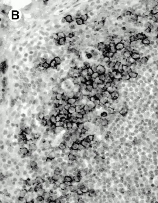 Fig. 8. Expression of PSGL-1 in human tissues. (A) Paraffin tonsil stained with KPL1. The vast majority of the lymphocytes in the T-cell zone (TZ) show dark staining, while the B-lymphocytes in the mantle (M) and germinal center (GC) do not stain. (B) A high magnification of paraffin embedded tonsil stained with KPL1. Plasma cells adjacent to the overlying epithelium show dark membrane staining. The mantle B lymphocytes in the right lower corner do not stain. (C) Plasma cells near vessels in skin stain well with KPL1. (D) Costaining of the cells in (C) with VS38 confirms their identification as plasma cells. / (E) Paraffin section of skin stained with KPL1. The Langerhans cells in epidermis and superficial dermis stain intensely in this example of Langerhans cell histiocytosis. The stained dendritic processes are apparent in the epidermis. (F) Langerhans cells in soft tissues also stain with KPL1. (G) Identification of Langerhans cells in (F) is confirmed by costaining with CD1a (immunoperoxidase with hematoxylin counterstain).