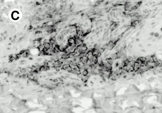 Fig. 8. Expression of PSGL-1 in human tissues. (A) Paraffin tonsil stained with KPL1. The vast majority of the lymphocytes in the T-cell zone (TZ) show dark staining, while the B-lymphocytes in the mantle (M) and germinal center (GC) do not stain. (B) A high magnification of paraffin embedded tonsil stained with KPL1. Plasma cells adjacent to the overlying epithelium show dark membrane staining. The mantle B lymphocytes in the right lower corner do not stain. (C) Plasma cells near vessels in skin stain well with KPL1. (D) Costaining of the cells in (C) with VS38 confirms their identification as plasma cells. / (E) Paraffin section of skin stained with KPL1. The Langerhans cells in epidermis and superficial dermis stain intensely in this example of Langerhans cell histiocytosis. The stained dendritic processes are apparent in the epidermis. (F) Langerhans cells in soft tissues also stain with KPL1. (G) Identification of Langerhans cells in (F) is confirmed by costaining with CD1a (immunoperoxidase with hematoxylin counterstain).