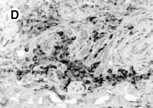 Fig. 8. Expression of PSGL-1 in human tissues. (A) Paraffin tonsil stained with KPL1. The vast majority of the lymphocytes in the T-cell zone (TZ) show dark staining, while the B-lymphocytes in the mantle (M) and germinal center (GC) do not stain. (B) A high magnification of paraffin embedded tonsil stained with KPL1. Plasma cells adjacent to the overlying epithelium show dark membrane staining. The mantle B lymphocytes in the right lower corner do not stain. (C) Plasma cells near vessels in skin stain well with KPL1. (D) Costaining of the cells in (C) with VS38 confirms their identification as plasma cells. / (E) Paraffin section of skin stained with KPL1. The Langerhans cells in epidermis and superficial dermis stain intensely in this example of Langerhans cell histiocytosis. The stained dendritic processes are apparent in the epidermis. (F) Langerhans cells in soft tissues also stain with KPL1. (G) Identification of Langerhans cells in (F) is confirmed by costaining with CD1a (immunoperoxidase with hematoxylin counterstain).