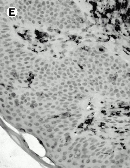 Fig. 8. Expression of PSGL-1 in human tissues. (A) Paraffin tonsil stained with KPL1. The vast majority of the lymphocytes in the T-cell zone (TZ) show dark staining, while the B-lymphocytes in the mantle (M) and germinal center (GC) do not stain. (B) A high magnification of paraffin embedded tonsil stained with KPL1. Plasma cells adjacent to the overlying epithelium show dark membrane staining. The mantle B lymphocytes in the right lower corner do not stain. (C) Plasma cells near vessels in skin stain well with KPL1. (D) Costaining of the cells in (C) with VS38 confirms their identification as plasma cells. / (E) Paraffin section of skin stained with KPL1. The Langerhans cells in epidermis and superficial dermis stain intensely in this example of Langerhans cell histiocytosis. The stained dendritic processes are apparent in the epidermis. (F) Langerhans cells in soft tissues also stain with KPL1. (G) Identification of Langerhans cells in (F) is confirmed by costaining with CD1a (immunoperoxidase with hematoxylin counterstain).