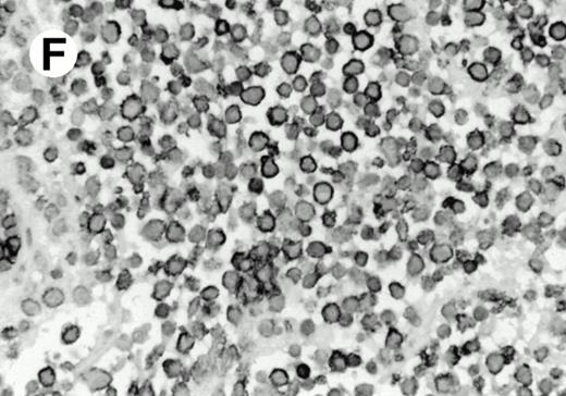 Fig. 8. Expression of PSGL-1 in human tissues. (A) Paraffin tonsil stained with KPL1. The vast majority of the lymphocytes in the T-cell zone (TZ) show dark staining, while the B-lymphocytes in the mantle (M) and germinal center (GC) do not stain. (B) A high magnification of paraffin embedded tonsil stained with KPL1. Plasma cells adjacent to the overlying epithelium show dark membrane staining. The mantle B lymphocytes in the right lower corner do not stain. (C) Plasma cells near vessels in skin stain well with KPL1. (D) Costaining of the cells in (C) with VS38 confirms their identification as plasma cells. / (E) Paraffin section of skin stained with KPL1. The Langerhans cells in epidermis and superficial dermis stain intensely in this example of Langerhans cell histiocytosis. The stained dendritic processes are apparent in the epidermis. (F) Langerhans cells in soft tissues also stain with KPL1. (G) Identification of Langerhans cells in (F) is confirmed by costaining with CD1a (immunoperoxidase with hematoxylin counterstain).