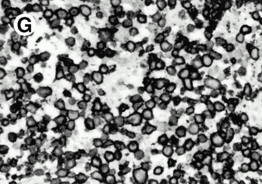 Fig. 8. Expression of PSGL-1 in human tissues. (A) Paraffin tonsil stained with KPL1. The vast majority of the lymphocytes in the T-cell zone (TZ) show dark staining, while the B-lymphocytes in the mantle (M) and germinal center (GC) do not stain. (B) A high magnification of paraffin embedded tonsil stained with KPL1. Plasma cells adjacent to the overlying epithelium show dark membrane staining. The mantle B lymphocytes in the right lower corner do not stain. (C) Plasma cells near vessels in skin stain well with KPL1. (D) Costaining of the cells in (C) with VS38 confirms their identification as plasma cells. / (E) Paraffin section of skin stained with KPL1. The Langerhans cells in epidermis and superficial dermis stain intensely in this example of Langerhans cell histiocytosis. The stained dendritic processes are apparent in the epidermis. (F) Langerhans cells in soft tissues also stain with KPL1. (G) Identification of Langerhans cells in (F) is confirmed by costaining with CD1a (immunoperoxidase with hematoxylin counterstain).