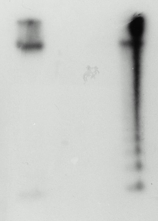 Fig. 2. Cord blood LAK cells can kill YAC-1 target cells by apoptosis. Cord blood mononuclear cells were cultured in IL-2 (500 U/mL) at 37°C. After 3 days, the cells were washed and 5 × 106 cells were incubated with 5 × 105 YAC-1 target cells that had been prelabeled with 125I-UdR. After 4 hours, DNA was extracted from the cell mixture, electrophoresed, and autoradiographed. The left-hand lane shows DNA extracted from YAC-1 cells in isolation. The right-hand lane shows YAC-1 DNA extracted from the cell mixture preparation. The DNA ladder is indicative of apoptosis. This figure is representative of three experiments.