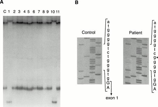 Fig. 3. Mutation detection in the genomic DNA from Patient 0300. (A) SSCP analysis of exon 1 and flanking sequences from a control (lane labeled c) and patients with XLA. Patients 0030 and 0025 are shown in lanes 1 and 10, respectively. (B) DNA sequence of the 5′ part of intron 1 from a control and from Patient 0030. The 3′ end of exon 1 is indicated in the control sequence. The T to G transversion in the patient is denoted by an asterisk.