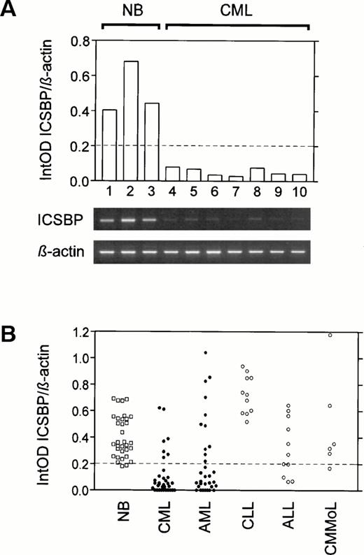Fig. 2. ICSBP-transcript numbers in peripheral blood from normal healthy individuals and patients with different kinds of leukemias. (A) Lack of ICSBP-transcript numbers in CML-patients was detected by a semi-quantitative RT-PCR assay. Comparison of three healthy normal blood donors (NB; lanes 1 through 3) with four CML patients at diagnosis (CML; lanes 4 through 7) and three hydroxyurea-treated CML patients (CML, lanes 8 through 10). The expression level is displayed as integrated optical density (IntOD). (B) As (A), except that ICSBP-transcript numbers of 33 normal healthy blood donors, 34 CML, 32 AML, 11 CLL, 11 ALL, and 6 CMMoL patients were compared.