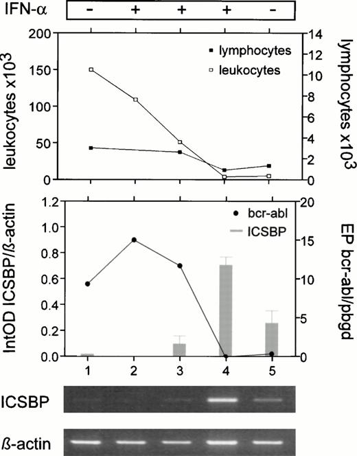 Fig. 4. ICSBP-transcript numbers, increasing upon in vivo treatment with IFN-α, correlated with impairment ofbcr-abl-transcript (•), leukocyte (□), and lymphocyte (▪) numbers. The sample at diagnosis exhibits few ICSBPtranscripts, even with only 1% blast cells (lane 1). Samples during IFN-α treatment showed an increase of ICSBP (lane 2: after 3 weeks, bone marrow; lane 3: 6 weeks; lane 4: 36 weeks), and a decrease of ICSBP after IFN-α was withdrawn (lane 5: 68 weeks). The mean of three experiments is displayed. All analyzed metaphases during the patient's course were 100% Philadelphia-chromosome positive. The relative equivalence points (EP) of bcr-abl and the reference gene, pbgd, were determined by quantitative PCR.