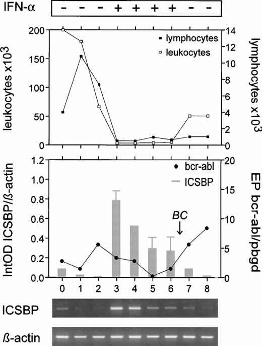 Fig. 5. Increase of ICSBP-transcript numbers in a CML patient during in vivo IFN-α treatment, inversely correlated with bcr-abl-transcript (•), leukocyte (□), and lymphocyte (▪) numbers. At diagnosis (lane 0), and during treatment with hydroxyurea (lane 1: after 0.5 weeks; lane 2: 1 week) few ICSBPtranscripts were visible, although in this period the patient exhibited only 0% to 3% blast cells. During early IFN-α treatmentICSBP-transcript numbers increased (lane 3: 15 weeks; lane 4: 15 weeks), but decreased with progression to blast crisis (lane 5: 22 weeks; lane 6: 31 weeks; lane 7: 37 weeks, blast crisis with 60% blast cells; lane 8: 37 weeks, blast crisis, bone marrow). The mean of three experiments is displayed (±SEM). The patient exhibited an additional cytogenetic aberration, a monosomie 7, during blast crisis. BC, blast crisis.