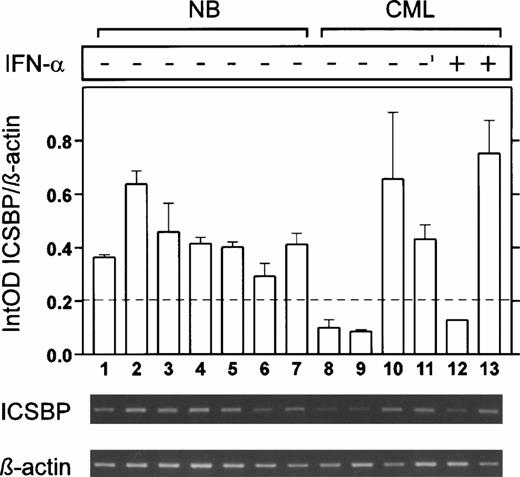 Fig. 6. ICSBP-transcript numbers in CD19+ B cells from normal healthy individuals and CML patients. High transcript levels were detected in cells from normal individuals (lanes 1 through 7), low levels in two of three CML patients without IFN-α (lanes 8 through 10) whereas another patient with high ICSBP levels had received IFN-α before (lane 11; IFN-α was withdrawn 6 months before sample was taken). One of two CML patients still under IFN-α exhibited low, the other high ICSBP levels (lanes 12 and 13). The mean of three experiments is displayed (±SEM).