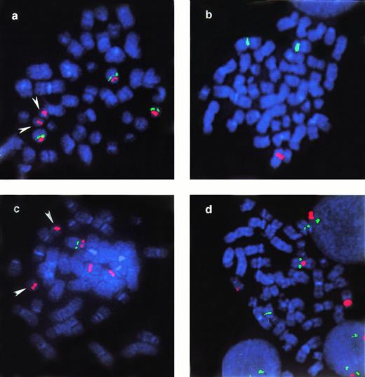 Fig. 2. Examples of FISH analysis performed in case 18. Arrowheads in a and c indicate normal chromosome 21 that cohybridize with pUC 1.76 probe for the centromere of chromosome 13. Probes applied: (a) pUC 1.76 (cen 13/21) (red) and 911F6 (green). The picture shows a metaphase with two copies of normal chromosome 13 and one der(13): YAC 911F6 hybridizes on both normal 13 and on the der(13); (b) pBR-12 (cen-12) (green) and RB1 (red). Only one red signal, corresponding to RB1 gene, is kept on normal 13; (c) pUC 1.76 (red) and 937C7 (green). This metaphase represents the subclone with one normal 13 and two copies of der(13): YAC 937C7 is only mantained on normal 13; (d) pBR-12 (red) and 935G2 (green) in a metaphase with two copies of normal 13 and one der(13): YAC935G2 is present in three copies, on the two normal 13 and on the der(12).