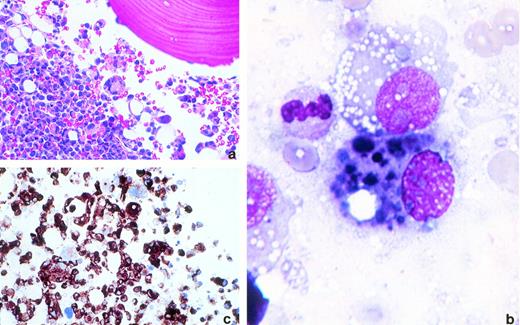 Melanomatous bone marrow invasion. Bone marrow biopsy specimen and aspirate from a patient with disseminated malignant melanoma. (a) Bone marrow biopsy specimens. The bone marrow is almost completely replaced by sheets of neoplastic cells with pleomorphic nuclei, prominent nucleoli, and abundant pink cytoplasm. Some malignant cells display prominent vacuolization (hematoxylin and eosin, original magnification × 200). (b) Bone marrow aspirate. Myeloid precursors containing multiple, irregular, darkly pigmented, melanin-containing vacuoles (Wright's stain, original magnification × 1,000). (c) Bone marrow biopsy specimen. The neoplastic cells are srongly reactive to HMB45 (immunoperoxidase, original magnification × 400). (Courtesy of Niyati Bhagwati, MD, Rommel Seno, MD, and Leslie Oleksowicz, MD, Montefiore Hospital and The Albert Einstein Cancer Center, 111 E 210th St, Bronx, NY 10467.)