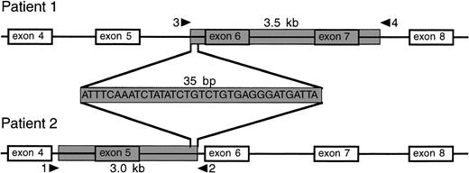 Fig. 3. Localization of deletions in the CYBB gene of the two patients. The shaded area indicates the deletions, comprising a 3.5-kb nucleotide stretch from intron 5 to intron 7 in patient 1 (the eldest brother) and a 3.0-kb nucleotide stretch from intron 4 to intron 5 in patient 2 (the youngest brother). The deletions overlap for 35 bp.