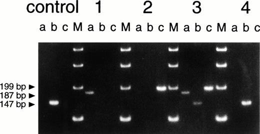 Fig. 4. Size analysis of PCR products from genomic DNA. Primer 1 (sense) was chosen on intron 4, primer 2 (antisense) on intron 5, primer 3 (sense) on intron 5 and primer 4 (antisense) on intron 7 (for positions, see Fig 3; for compositions, see Table 1). Primers 2 and 3 hybridize with DNA sequences within the deletions of patient 1 and patient 2, respectively (Fig 3). Therefore, PCR (a), with primers 3 and 4, only leads to product formation with DNA from patient 1 (not with DNA from a healthy control donor because these primers then hybridize too far apart to lead to product formation under the PCR conditions used). PCR (b), with primers 2 and 3, only leads to product formation with DNA from a healthy control donor. PCR (c), with primers 1 and 2, only leads to product formation with DNA from patient 2. The figure shows the results of PCR (a), (b), and (c) obtained with DNA from a healthy control donor, patient 1 (the eldest brother), patient 2 (the youngest brother), the mother of the patients (3), and the maternal grandmother of the patients (4). The four lanes marked M contain size markers of 100 bp.