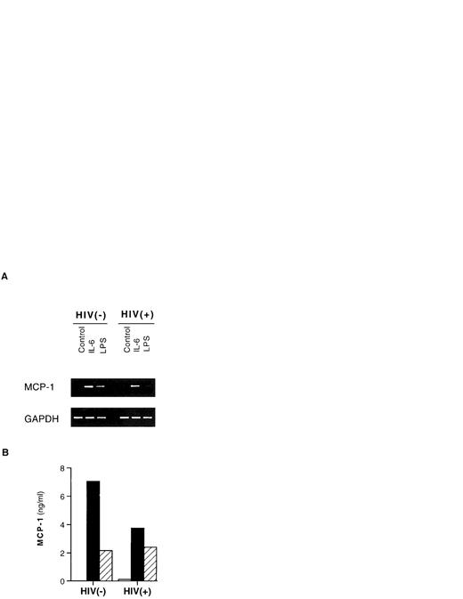 Fig. 2. Induction of MCP-1 mRNA and protein by IL-6 and LPS in PBMCs. One HIV-negative and one HIV-positive individual are shown. PBMCs were cultivated for 24 hours with medium alone (control), IL-6 (0.24 nmol/L), or LPS (1 μg/mL). (A) The cells were pelletted and frozen until processed for RT-PCR analysis of MCP-1 mRNA compared with the levels of expression of the housekeeping gene GAPDH. (B) Cell culture supernatants were harvested and frozen at −80°C until tested for MCP-1 protein content by ELISA. Similar results were obtained with PBMCs from two additional HIV-negative and two HIV-seropositive individuals cultured under the same conditions for 24 hours. (□) Unstimulated; (▪) IL-6 (0.24 nmol/L); (▨) LPS (1 μg/mL).