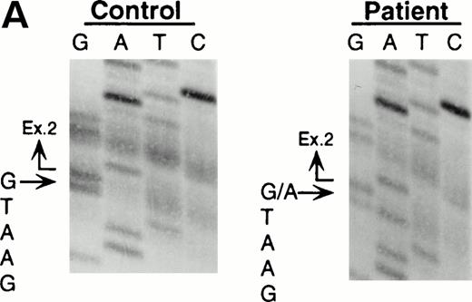 Fig. 2. Identification of the maternal mutation at the splice donor site in intron 2. (A) Sequence (sense) of the exon 2/intron 2 junction in amplified genomic DNA. Genomic fragments containing exon 2 were amplified from a control (left) and the patient (right) and sequenced directly. A mutation at the splice donor site in intron 2 (G+1 → A) is indicated by arrows. (B) Detection of the splice site mutation by the BspMI digestion. Amplified genomic fragments (690 bp) from intron 1 (bp 14,901) to intron 2 (base pair 15,590) was digested with BspMI, electrophoresed in 2.0% agarose gel, and stained with ethidium bromide. The fragment has twoBspMI recognition sites at bp 15,282 and 15,344, predicting 62-, 246-, and 382-bp fragments in the control lane. Loss of theBspMI site (base pair 15,282) by the mutation results in the undigested fragment (308 bp). Lane 1, control; lane 2, father; lane 3, mother; and lane 4, patient. BspMI digestion shows the patient and his mother were heterozygous for the splice site mutation.
