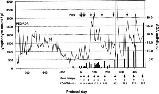 Fig. 3. Clinical course before and after gene therapy. Gene therapy started on August 1, 1995 (protocol day 0) with the patient receiving a total of 10 infusions to date. PEG-ADA therapy was initiated at 15 months of age. The lymphocyte count is indicated by a solid line and CD4/CD8 ratio was measured using PBL before infusion. ADA activity shown by a solid bar is expressed as nanomoles of inosine and hypoxanthine produced per minute by 108 cells. Replacement of IVIG after gene therapy is shown as an arrow. The patient received a Ig replacement (2.5 g) monthly before gene therapy.