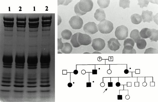 Fig. 1. (Left) 3.5% to 17% exponential gradient SDS-polyacrylamide gel of total membrane proteins stained with Coomassie blue, showing a reduction of spectrin content in the patient (lane 2) compared with the control (lane 1). (Upper right) Blood smear of the propositus showing regular numbers of spherocytes and acanthocytes. (Lower right) Family pedigree showing all affected members from two generations. Splenectomized individuals are indicated by asterix and the proband is indicated by an arrow.