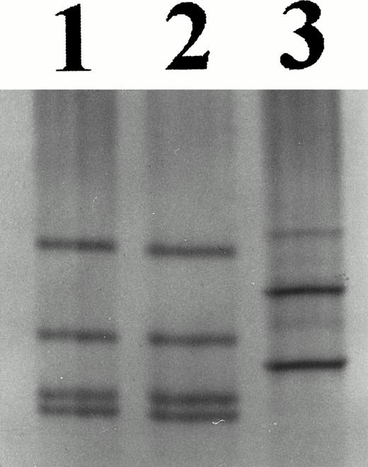 Fig. 2. Nonradioactive SSCP of exon 2 showing a band shift in the amplification products of the patient (lane 1) and his mother (lane 2), but absent in a control (lane 3).