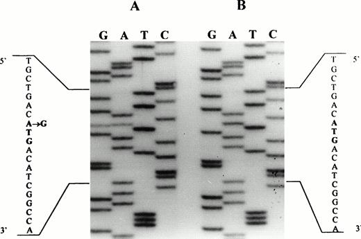 Fig. 3. Direct sequencing of the amplified DNA from a control (B) and the patient (A), showing an A → G substitution in the latter. The initiation codon is indicated by bold letters.