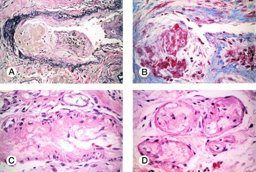 Fig. 7. EC injury in a case of antiphospholipid antibody syndrome (photographs courtesy of Emma E. Furth, MD, Department of Pathology and Laboratory Medicine, University of Pennsylvania, Philadelphia, PA). EC injury seen in a duodenal biopsy from a 40-year-old woman who presented with profuse intestinal bleeding and was found to have a lupus anticoagulant and a markedly positive anticardiolipin antibody. (A) Elastic stain (original magnification × 200) highlighting a fresh thrombus (right) with the beginning stages of organization and EC ingrowth, an older organized thrombus with fibroblast proliferation (center), within a vessel showing vacuolated, injured, and disrupted ECs. (B) A trichrome stain (original magnification × 400) of the same field highlighting the thrombus material (red acellular material on the right) with early stages of organization. (C) A hematoxylin and eosin (H and E) stain (original magnification × 400) showing fibrinoid intimal necrosis (right) in the absence of an inflammatory reaction within a small vessel in the same duodenal biopsy as shown in (A) and (B). The ECs show marked vacuolization (left). The surrounding eosinophilic vascular cells are smooth muscle cells surrounded by fibroblasts. (D) A higher power view (original magnification × 600) of the same biopsy showing four capillaries with grossly vacuolated ECs and luminal effacement.