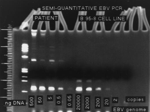 Fig. 1. The five lanes on the right, labeled “B 95-8 Cell Line”, represent the electrophoresis of DNA from this cell line, which is used as a control to determine the sensitivity of the semiquantitative EBV PCR assay. DNA from a known number of cells is run in each lane, and the lowest dilution at which a band is still visible corresponds to 10 cells. Because each B 95-8 cell has two copies of the EBV genome, the sensitivity of this assay is 20 copies EBV DNA. The first five lanes represent different amounts of DNA per lane from a patient. The last visible band corresponds to the 0.05-ng dilution. The number of copies of EBV genome per microgram DNA (in this case 400,000 copies/μg DNA) is calculated by dividing the sensitivity of the assay (20 copies/μg DNA) by the concentration of DNA for the last visible band (0.05 × 10−3 μg).