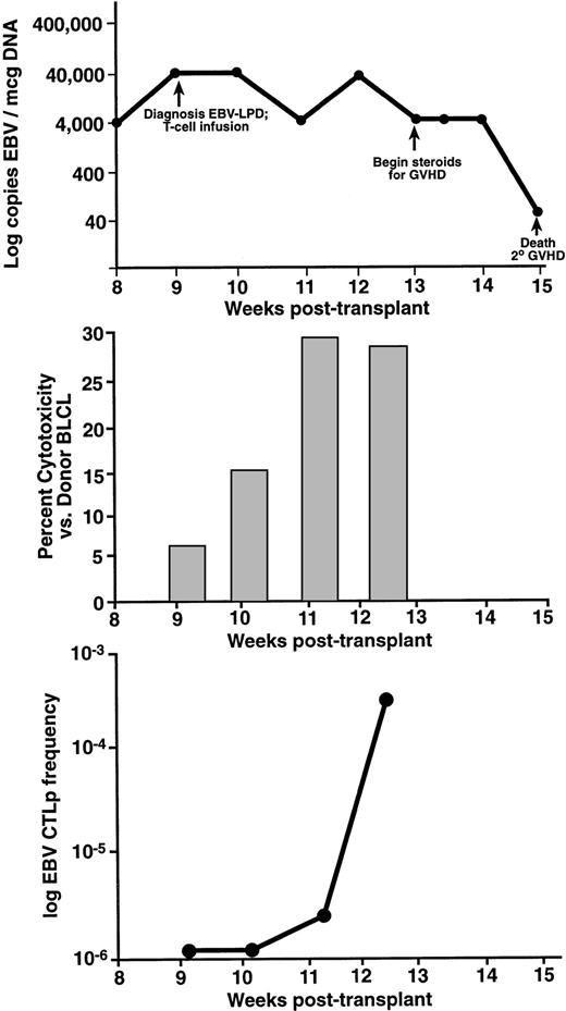 Fig. 2. UPN 440 developed EBV-LPD 9 weeks after an unrelated, T-cell–depleted SCT. Levels of EBV DNA determined by semiquantitative PCR are presented on the top panel (A). Two weeks after receiving a donor leukocyte infusion, this patient had a decrease in levels of EBV DNA (B). There was a progressive increase in the amount of EBV-specific cytotoxicity against the donor BLCL, which had reached normal levels at 2 weeks postinfusion (C). This correlated with the development of normal levels of EBV-specific, cytotoxic T-cell precursor frequencies. This patient died from graft-versus-host disease.