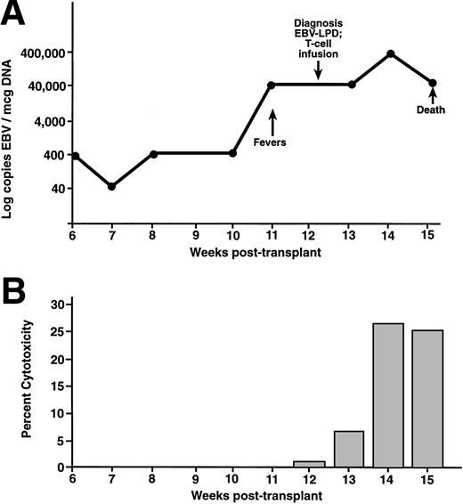 Fig. 3. UPN 381 developed fevers and hepatosplenomegaly 11 weeks after an unrelated T-cell–depleted SCT (A). This patient received a donor leukocyte infusion at the time of diagnosis, at which time there were 40,000 copies of EBV/μg DNA in the peripheral blood. After the infusion, there was a progressive increase in the amount of EBV-specific cytotoxicity against the donor BLCL (B). This patient died secondary to pulmonary failure, complicated by persistent EBV-LPD in the liver and lungs.