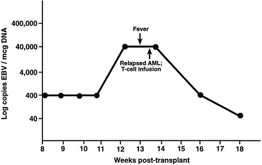 Fig. 4. UPN 386 received a T-cell–depleted, unrelated donor bone marrow transplant for acute myelogenous leukemia and developed fever 12 weeks posttransplant. There was no evidence of EBV-LPD on computerized tomography, but levels of EBV DNA were 40,000 copies/μg DNA. This patient was noted to have relapsed leukemia at this time, received a donor leukocyte infusion, and had a decrease in EBV DNA to the normal range.