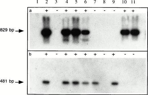 Fig. 5. PCR analysis of hematopoietic progenitor colonies transduced with G1Na and LNL6 retroviral vectors. DNA samples isolated at week 2 posttransduction from 10 representativeneoR hematopoietic colonies (lanes 2 through 11) from human BM CD34+ cells transduced with G1Na on d1 followed by LNL6 on d5 were subjected to PCR analysis using G1Na-specific (a) or LNL6-specific (b) primer pairs. The products of PCR amplification were electrophoresed on 2% agarose gel and visualized on Southern blots using 32P-labeledneo-specific sequences. While 4 colonies (lanes 2, 4, 5, and 6) showed the presence of both retroviral vectors, 2 colonies each (lanes 7 and 9 and lanes 10 and 11), respectively, showed sequences specific for either LNL6 or G1Na vectors alone. Lane 1 is a negative control. PCR amplification of DNA obtained from 2 colonies (lanes 3 and 8) was not successful.
