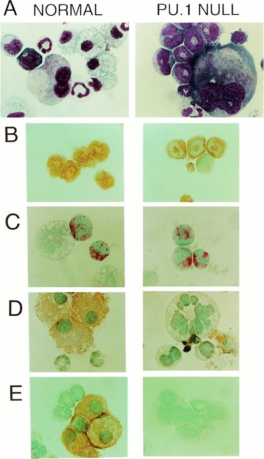 Fig. 4. CAE+ and Gr-1+ cells (neutrophils) but not F4/80+ or M-CSF receptor (c-fms)+ cells (monocyte/macrophages) developed in vitro from PU.1 deficient progenitors when cultured in SCF, IL-3, and IL-6. (A) Wright-Giemsa-stained cytospins of representative multilineage colonies from control and PU.1 null individuals revealed a conspicuous absence of macrophages in PU.1 deficient colonies. However, neutrophils and megakaryocytes were evident in both panels (1,150×). (B) The neutrophil enzyme CAE, demonstrated by a pink reaction product, was evident in PU.1 deficient and control polymorphonuclear cells. Note the larger, nonstaining macrophage in the control individual (1,150×). (C) Both PU.1 deficient and control polymorphonuclear cells expressed the cell surface marker Gr-1 which was demonstrated by immunoperoxidase staining. Detection was with diaminobenzidine (DAB) which yields an orange-brown reaction product (1,150×). (D) M-CSF receptor immunostaining revealed no M-CSF receptor-positive cells in PU.1 deficient colonies. Cell debris was present that stained nonspecifically with DAB in PU.1 null cultures (1,150×). (E) Immunocytochemical staining for the macrophage marker F4/80 revealed no positive cells in PU.1 deficient colonies, whereas many orange-staining F4/80+ cells were found in control colonies (1,150×).