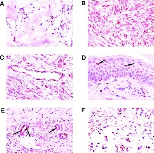 Fig. 2. Expression of the KSHV cyclin D gene in cutaneous KS lesions. (A) Early patch-stage lesion. Note hybridization signals in spindle cells forming the narrow vascular spaces in the dermis. (B) Nodular/tumor-stage lesion showing large numbers of hybridization signals in lesional spindle cells. (C) Well-formed blood vessel in the dermis adjacent to nodular lesion of KS. Note abundant hybridization signals in the vascular endothelial cells. (D) Plaque-stage lesion of KS with scattered keratinocytes in the overlying epidermis containing a few hybridization signals. Some of the labeled keratinocytes (arrows) are isolated and are surrounded by nonlabeled cells indicating that diffusion of label between cells did not occur. (E) Eccrine ductular epithelial cells containing hybridization signals. Only some of the eccrine epithelial cells are labeled in this plaque-stage KS lesion. Some of the labeled cells (arrows) are isolated and are surrounded by nonlabeled epithelial cells. (F) Nodular KS lesion containing scattered mononuclear cells, morphologically consistent with lymphocytes or histiocytes, which are labeled. All panels, ISH with catalyzed signal amplification, DAB chromogen, toluidine blue and hematoxylin counterstain. (A through F) Original magnification × 270.