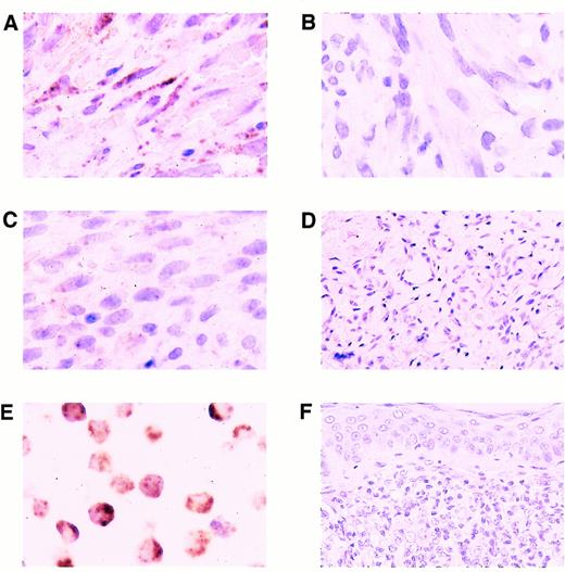 Fig. 3. Expression of KSHV cyclin D. (A) Higher magnification, same nodular-stage lesion of KS as shown in Fig 2B. Note abundant signal in the cytoplasm of lesional spindle cells; fewer nuclear signals are present. (B) Same nodular-stage KS tissue hybridized with the biotinylated probe of irrelevant specificity. Hybridization signals are not detected. (C) Nodular-stage lesion of KS hybridized with the KSHV-specific probe after RNAse digestion of the tissue. Only a few nuclear signals remain. (D) Benign cutaneous hemangioma, which did not contain any labeled cells. (E) BC-3 positive control cell line showing abundant cytoplasmic and nuclear hybridization signals. (F) Non-AIDS–related cutaneous NHL, which did not contain any labeled cells. All panels, ISH with catalyzed signal amplification, DAB chromogen, hematoxylin counterstain. (A, B, C, and E) Original magnification × 660. (D and F) Original magnification × 270.